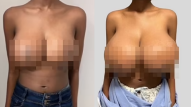 Woman's breasts quadruple after taking covid vaccine